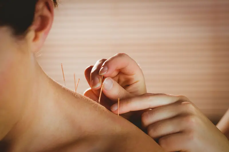 Aiguilles d'acupuncture posées sur l'épaule
